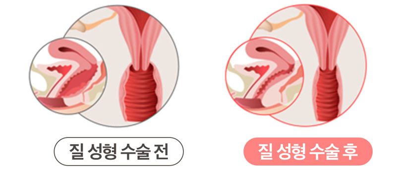 질 성형 수술 전후 비교