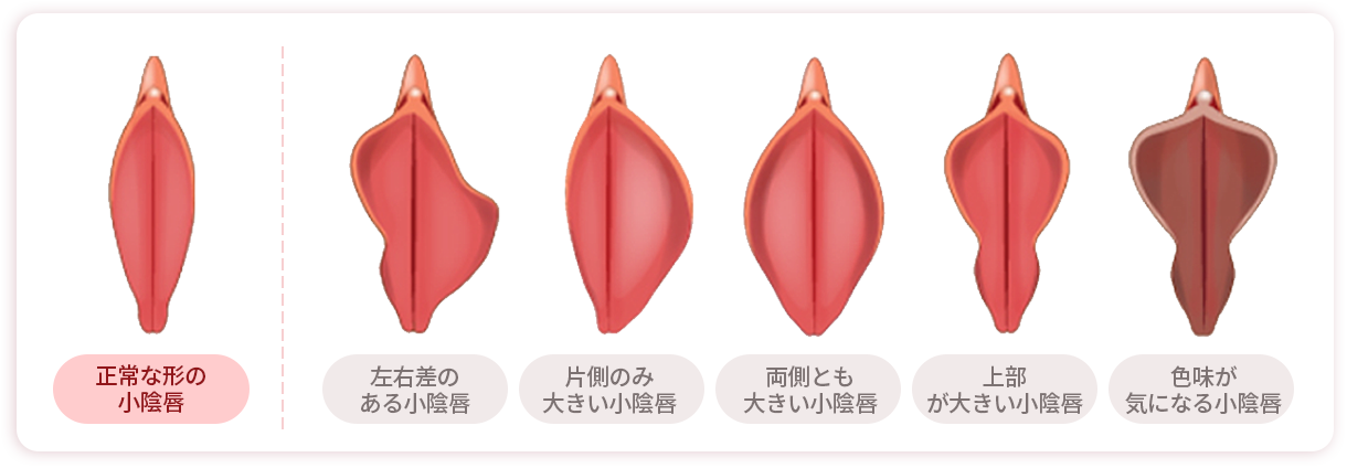 꽃잎모양의 정상적인 소음순 / 불균형 소음순 / 한쪽이 큰 소음순 / 양쪽이 큰 소음순 / 윗쪽이 큰 소음순 / 검은 소음순
