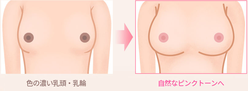 유두, 유륜이 검은 경우 → 미백 시술을 통한 핑크빛으로 변화